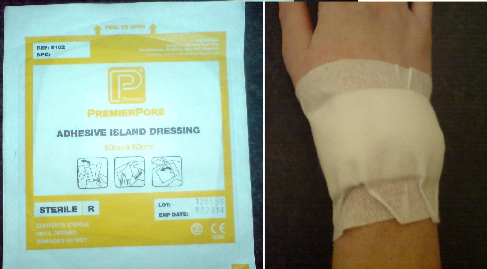An adhesive island dressing in its packaging and applied to a hand